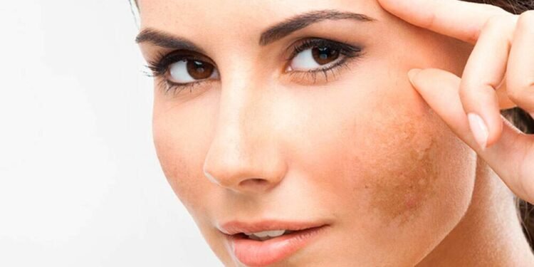 Melasma: Compreendendo as Manchas Faciais e Como Tratá-las