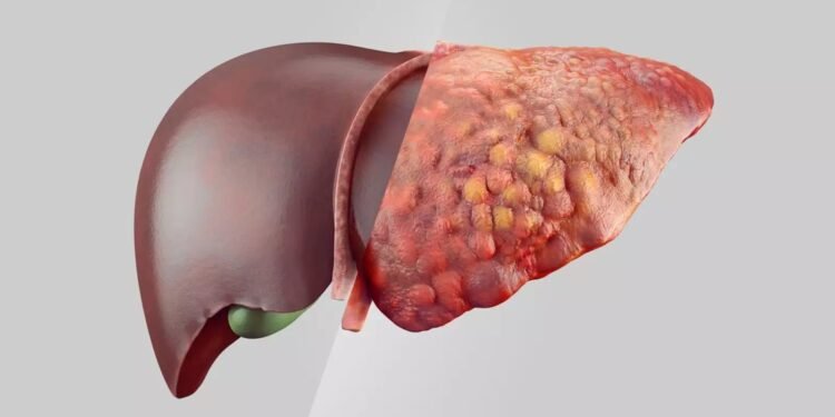 Gordura no Fígado: Um Alerta para a Saúde do Seu Principal Órgão Metabólico