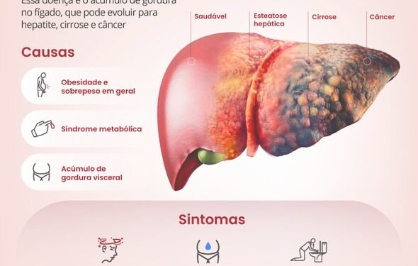 Gordura no Fígado Atinge 30% da População