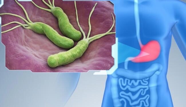 H. pylori Não É Único Culpado no Câncer de Estômago