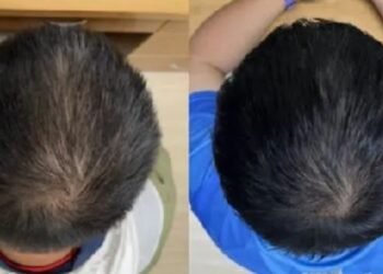 Calvície: Tônico Inovador Promete Crescimento Capilar