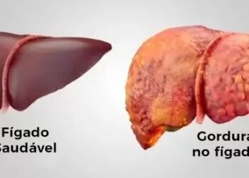 Gordura no Fígado: Entenda a Esteatose