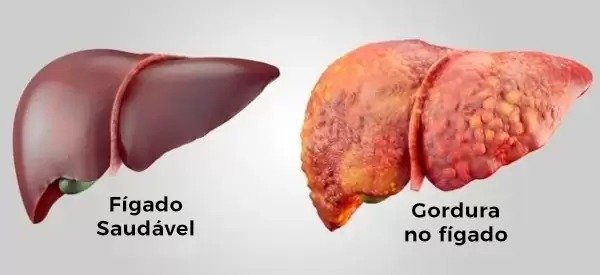 Gordura no Fígado: Entenda a Esteatose