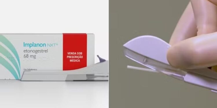 Implanon no SUS: Contraceptivo de Longa Duração Gratuito para Mulheres a Partir de 2025